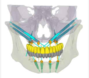 Zygomatic and pterygoid full mouth dental implants