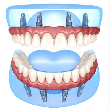 Upper and lower fixed zirconia full arch dental implants