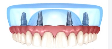 Single arch fixed dental implant zirconia restoration