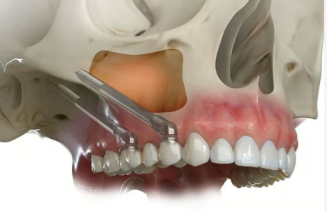 Zygomatic and pterygoid single arch dental implant restoration